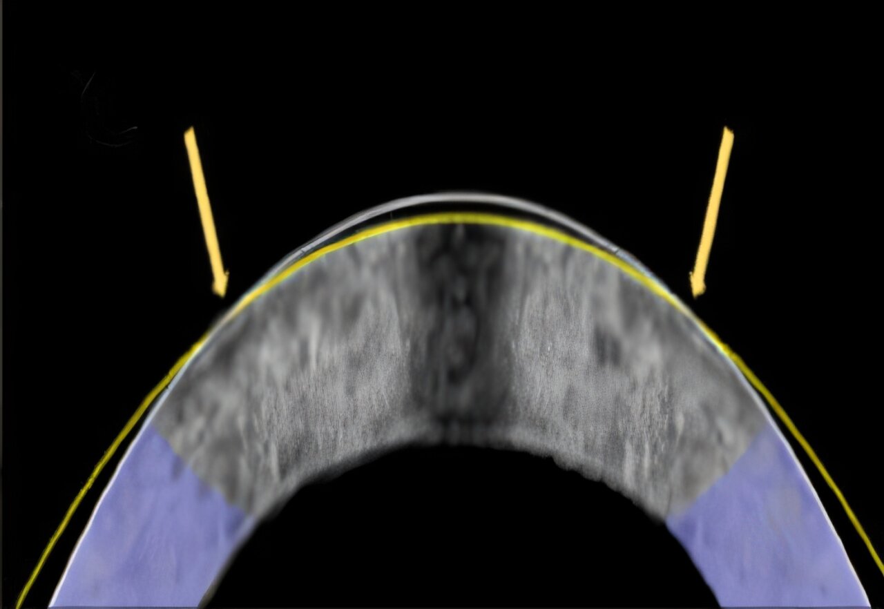 新型视力矫正术:用电化学方式重塑角膜