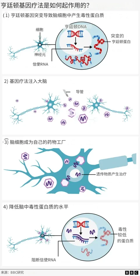 亨廷顿病首次得到治疗