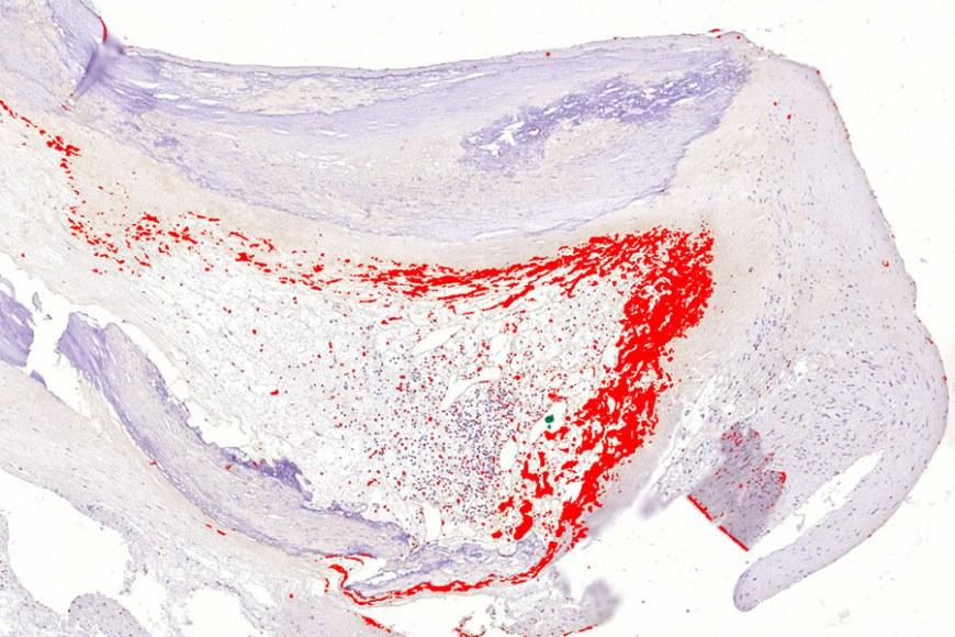 心梗或是潜伏的感染病