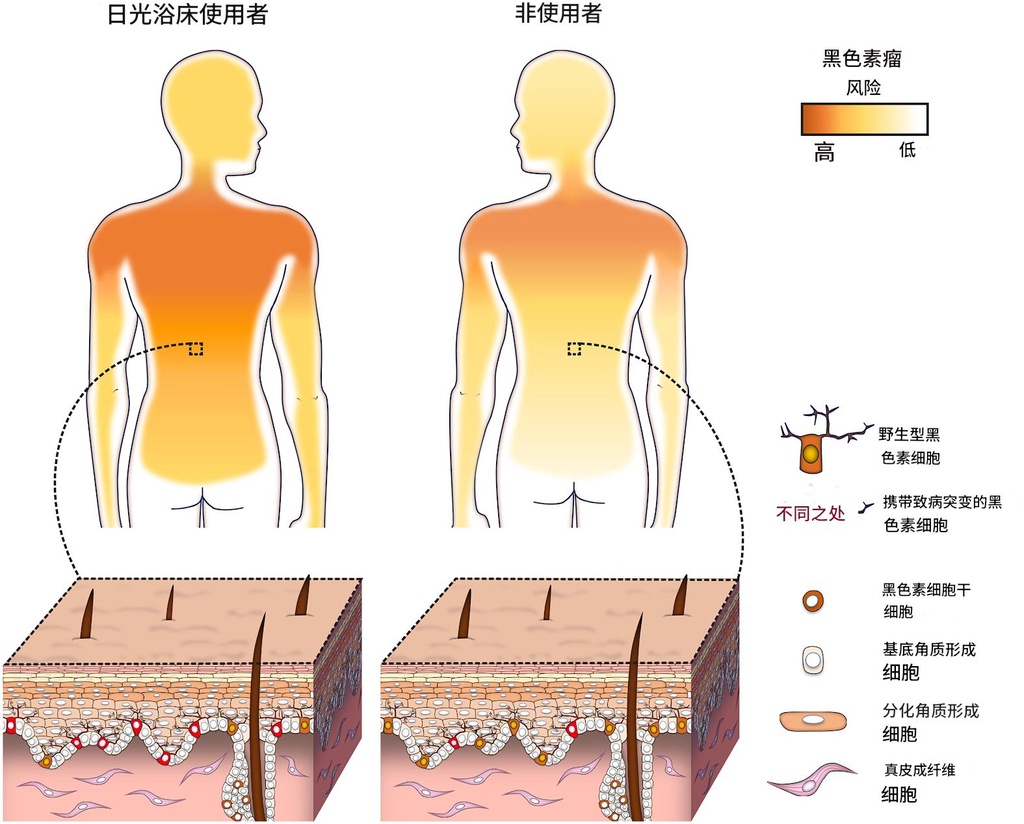 晒黑床让黑色素瘤风险增加3倍