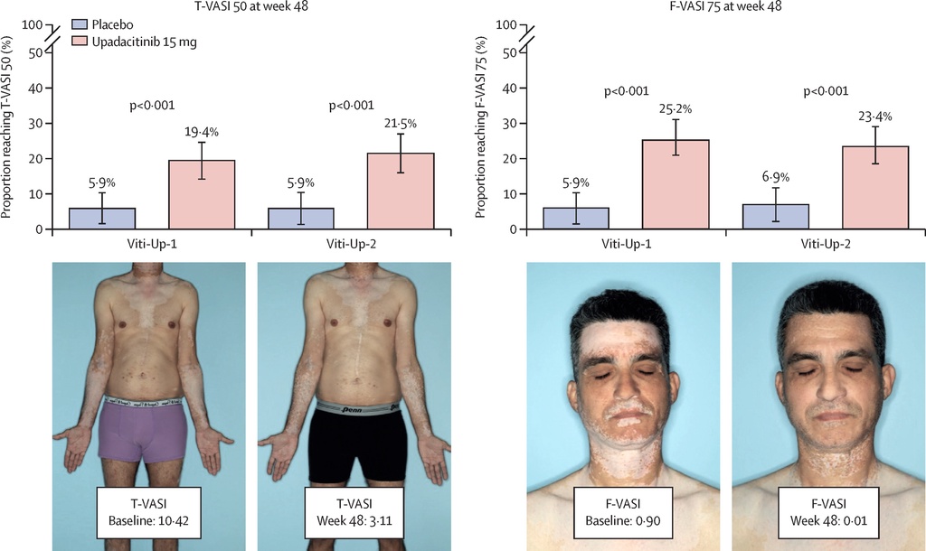 三期试验显示白癜风口服药让1/4患者的白斑恢复肤色