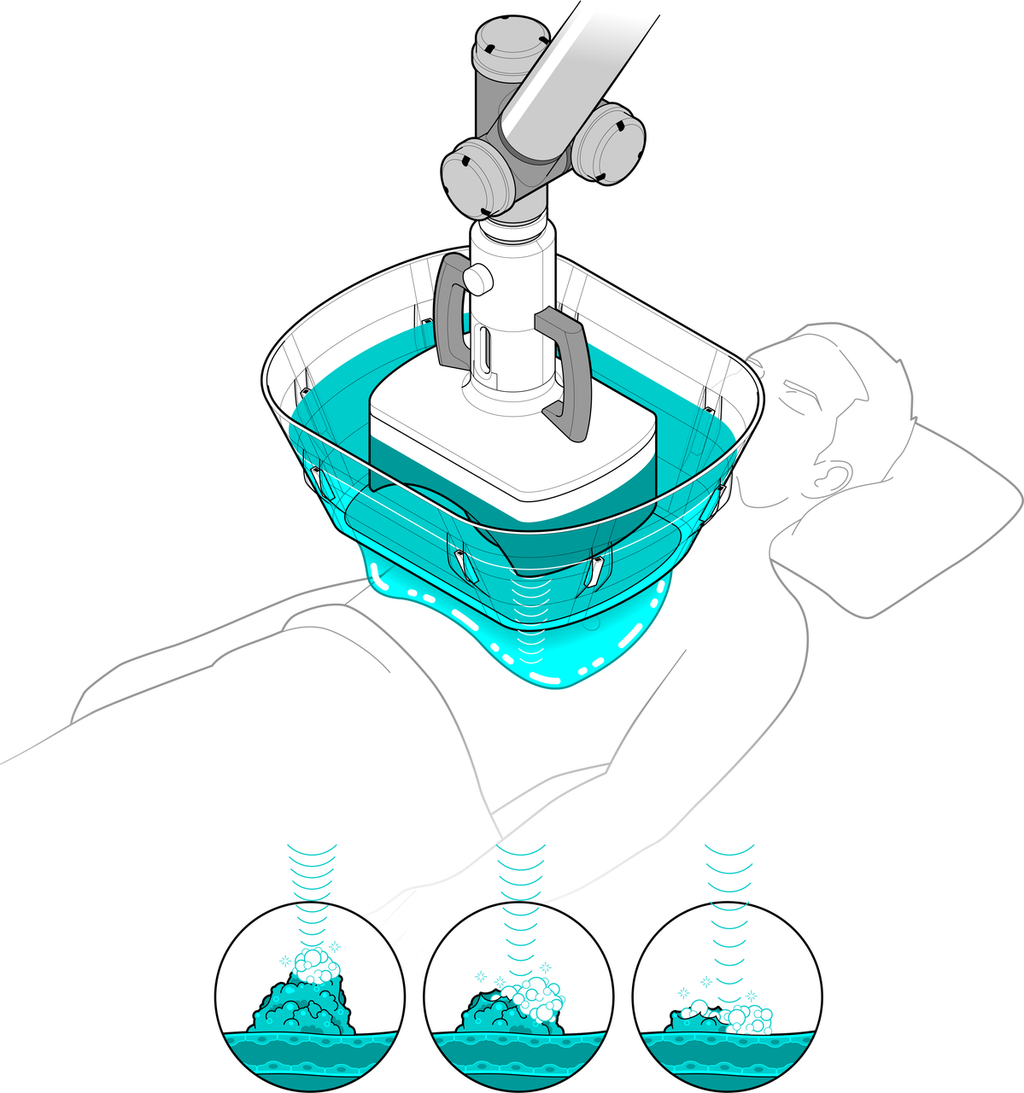 超声波正在挑战最难治的癌症