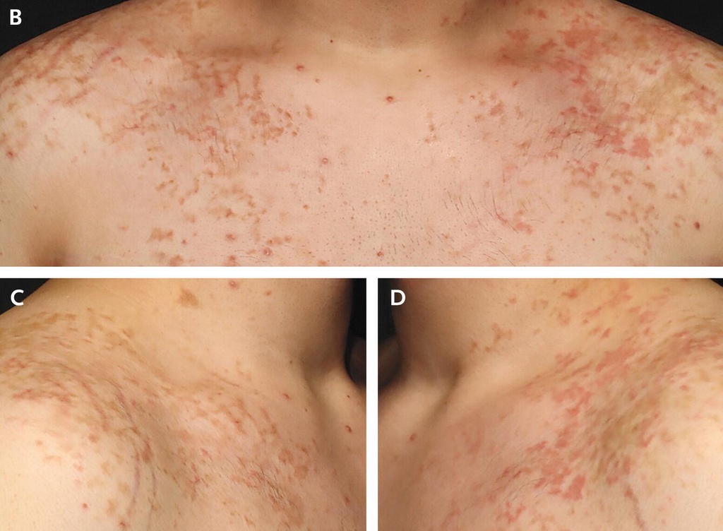 减肥减出“生酮疹”:低碳饮食的皮肤危机