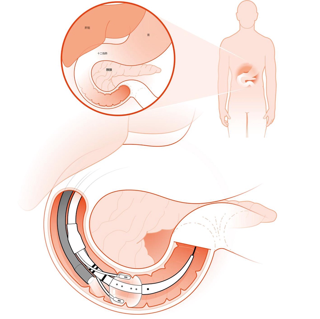 新装置可以解决GLP-1的停药后体重反弹